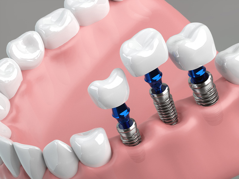 インプラント治療
