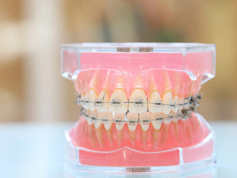 矯正治療（永久歯が生えそろった後～大人）